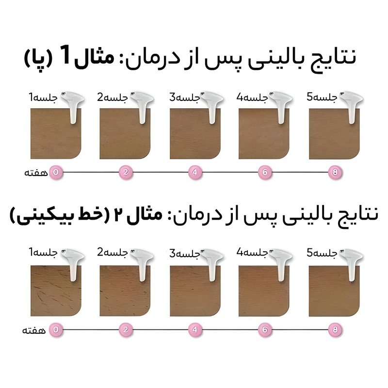 لیزر بدن فیلیپس لومیا مدل SC1997/00